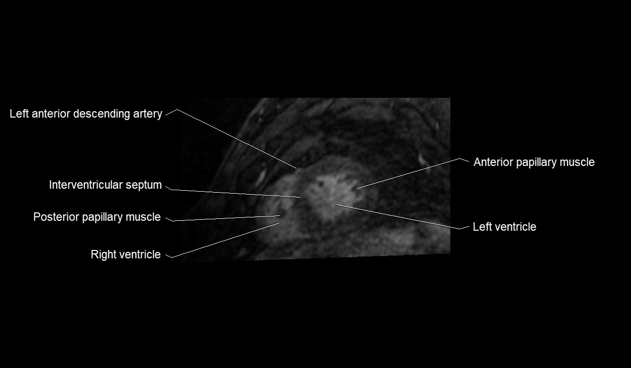 MRI heart and coronary arteries short axis anatomy image 32.webp